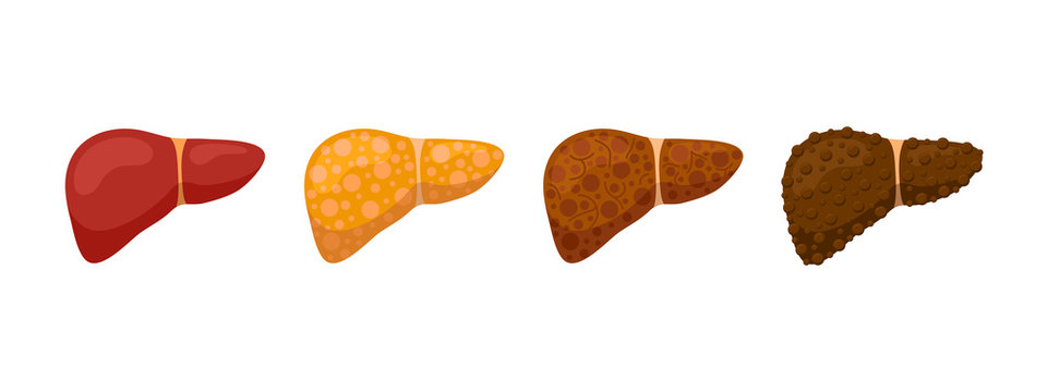 Stages human liver damage concept. Healthy liver steatosis fatty NASH fibrosis and cirrhosis. Vector cartoon reversible and irreversible condition illustration
