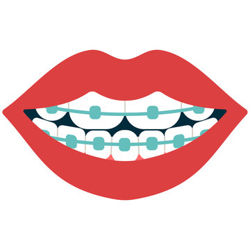 Dental braces vector cartoon illustration isolated on a white background.