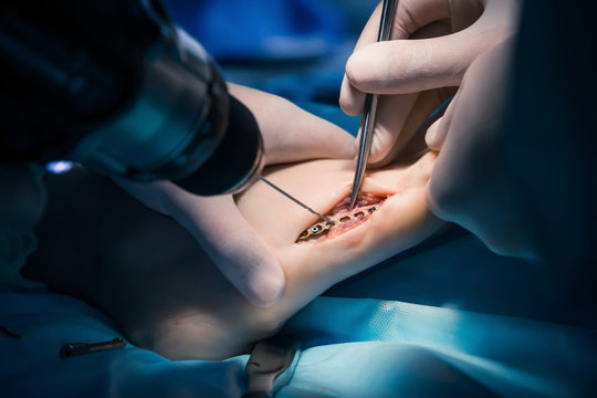 Surgeons in the operating room use a drill. Drill a broken foot bone to secure the plate.