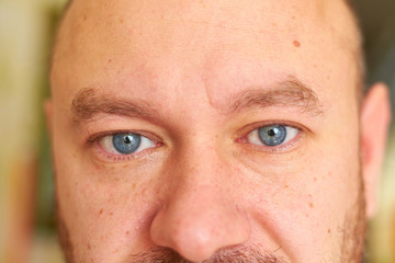 Obraz premium Watery, irritated eyes of a man.