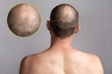 The concept of male alopecia and hair loss. Rear view of the man's head with a bald spot. Bare shoulders. Enlarged picture of the problem area - obrazy, fototapety, plakaty