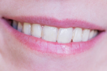 closeup of a woman's teeth and smiling