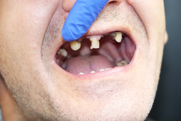 The man has rotten teeth, teeth fell out, yellow and black teeth hurt. Poor teeth condition,...