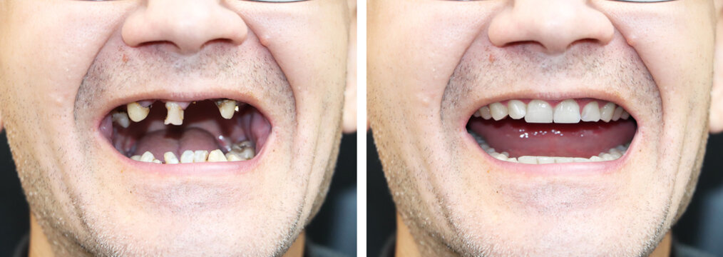 The patient at the orthodontist before and after the installation of dental implants. Tooth loss, decayed teeth, denture, veneers