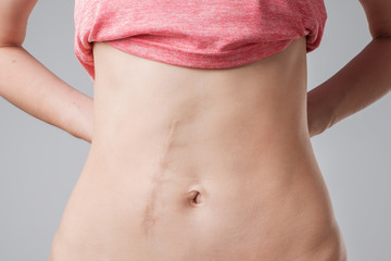 European woman with long abdominal scars after operation