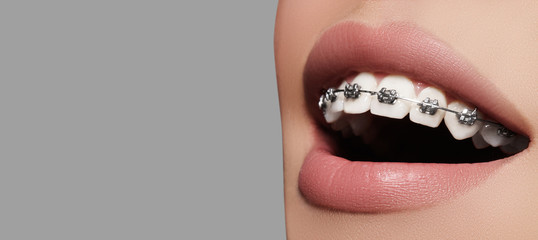 Beautiful white teeth with braces. Dental care photo. Woman smile with ortodontic accessories. Orthodontics treatment - obrazy, fototapety, plakaty