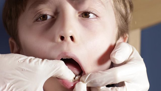 Dentist tries to extract primary shaky tooth at boy of six years. Closeup