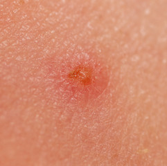 Little wound on human skin
