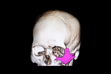 fracture zygoma and floor of orbit