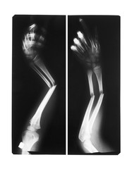 show double fracture arm bones