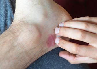 Scratching insect flea bite body chest foot by hand, itch