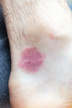 Flea bite closeup chest arm foot skin, bitten by insects bug