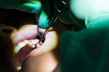 Close Up of Dentist Hand Moving a Decayed Tooth with Dental Instruments before Extraction