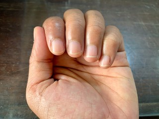 The woman's fingernail is short but lacking nourishment, so dry and hardened.