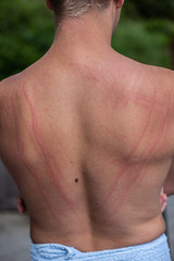 Naklejka premium Dermatographic urticaria (also known as dermographism, dermatographism or 