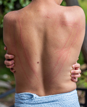 Dermatographic urticaria (also known as dermographism, dermatographism or "skin writing") is a skin disorder and one of the most common types of urticaria. Photo of skin writing on a back of a man.