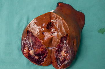 Human liver of liver diseases such as cancer.