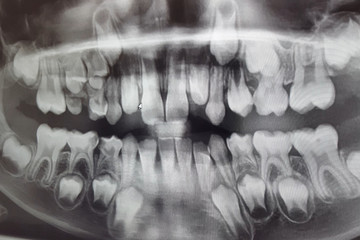 X-RAY PICTURE OF DAIRY AND NEW CHILDRENS TEETH.