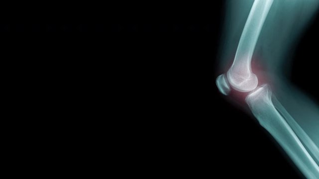 OA knee x-ray image footage with close up knee joint and red hight light, lateral view of OA knee with coppy space 