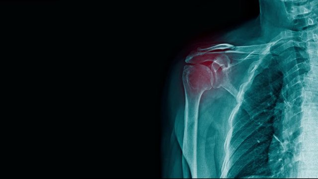 shoulder pain x-ray footage with red hight light on shoulder joint, clavicle fracture with pain around shoulder joint