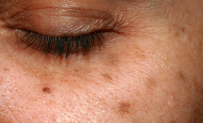 Fototapeta na wymiar Brown spots on the face. Pigmentation on the skin. Brown age spots on the cheek.