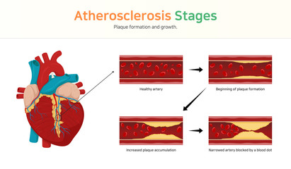 Atherosclerosis stages. Plaque formation and growth.