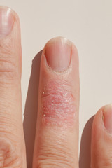 Ill Dermatitis Allergic Skin Rash Eczema Finger