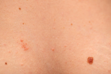 Fototapeta premium Dangerous nevus on skin - melanoma