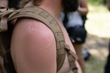 Sunburned shoulder with a backpack strap close-up. Sunburn of the skin.