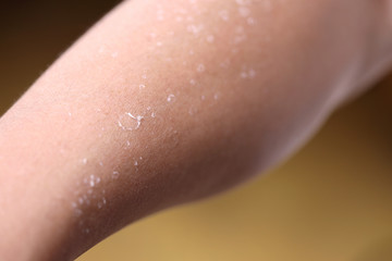 日焼けのあとの皮膚の剥離