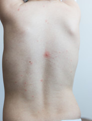 chicken pox varicella virus