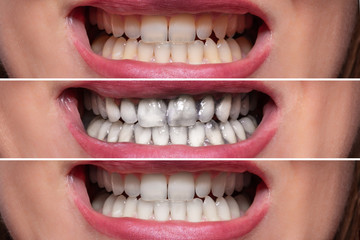 Person Teeth Before And After Cleaning