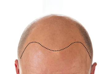 View of bald man's head