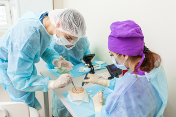 The doctor under the microscope recalculates the hair follicles. Baldness treatment. Hair transplant. Surgeons in the operating room carry out hair transplant surgery. Surgical technique that moves