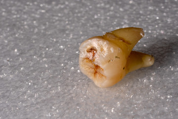 Close up of wisdom teeth effect. Wisdom teeth are the third and final set of molars that most people get in their late teens or early twenties.