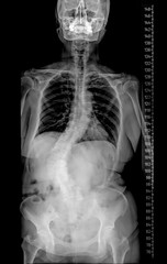 X-ray Whole human Spine for diagnosis scoliosis.