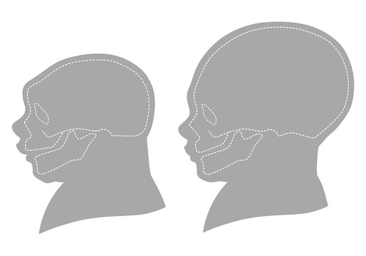 Silhouette image of the head and skull of a newborn child with a normal cranium and with microcephaly and severe microcephaly. Virus of Zika.  Isolated on white background