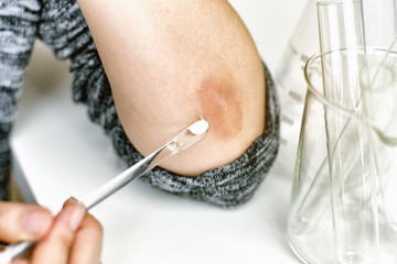 Skin allergy diseases problem, Close up of doctor doing treatment on atopic dermatitis rash, Female...