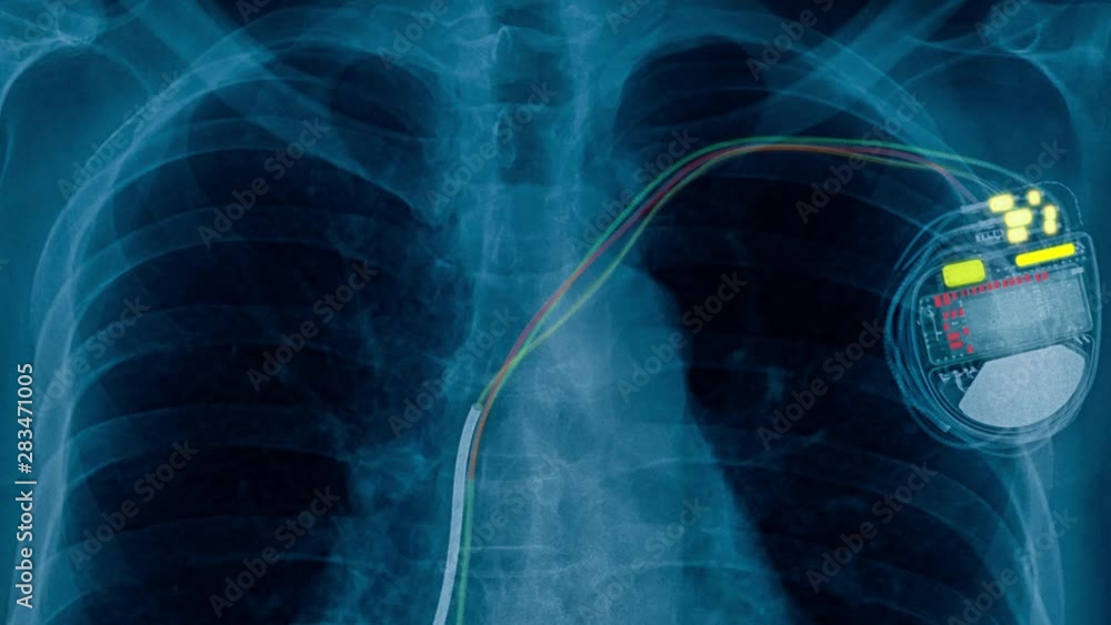 Poster x-ray footage pacemaker cell and show electrical effect 