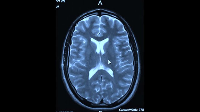 MRI Result Scan Of A Human Brain Magneto Resonance Therapy On The Computer Screen, Medical Science