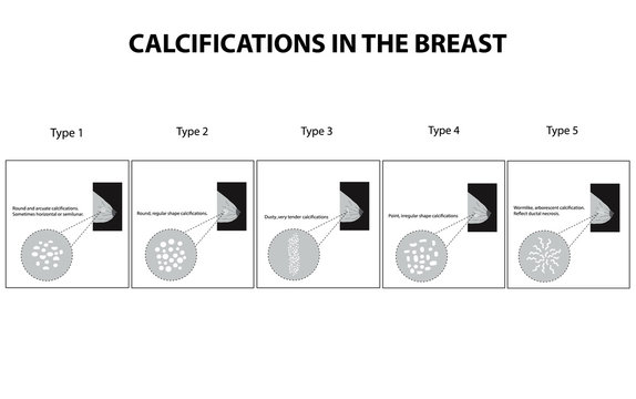 Classification of calcifications in the mammary gland. Mammography. The mammary gland. Infographics. Vector illustration on isolated background