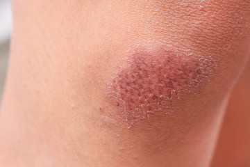 Bruise wounded texture on asian woman knee skin background