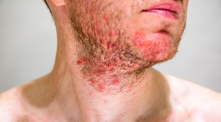 Detail of man's chin with seborrheic dermatitis in the beard area