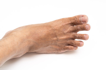 Asian man foot brown and dry skin