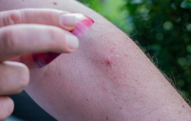 Wespe hat auf einem Arm zugestochen Wespenstich