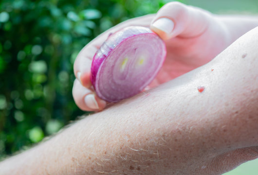 Wespe hat auf einem Arm zugestochen Wespenstich