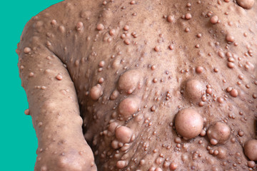 Neurofibromatosis (NF) is conditions in which tumors grow, symptoms include light brown spots on...