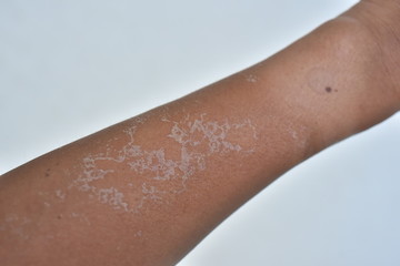 Arm dry skin peeling after sun burned