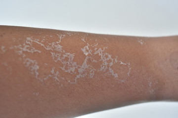 Arm dry skin peeling after sun burned