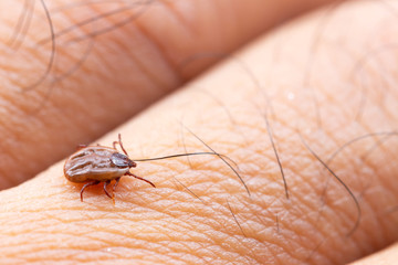 Tick filled with blood sitting on human skin.